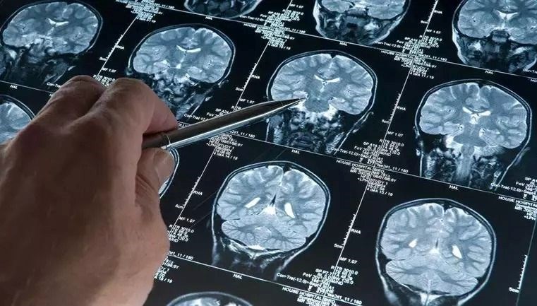 Alzheimer teşhisinde kan testi umudu